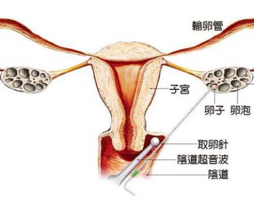 中国代孕一般多少钱,试管移植之前要做宫腔镜检查吗？